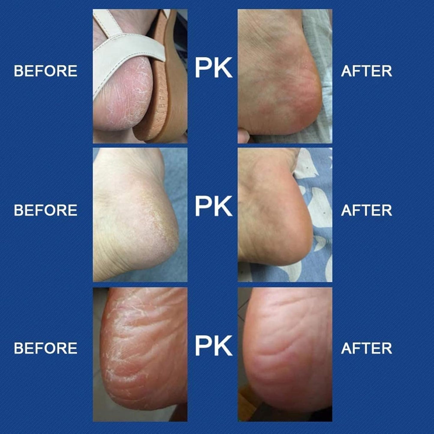 ZACVIN Foot Scrubber for Dead Skin Filer