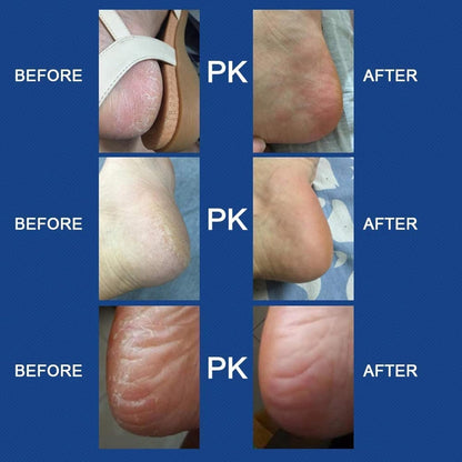 ZACVIN Foot Scrubber for Dead Skin Filer